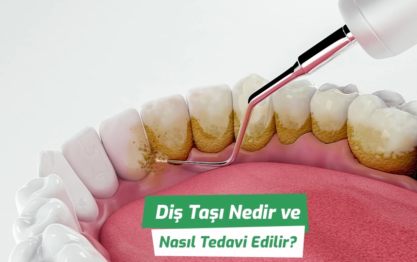 Diş Taşına Son! İşte Pırıl Pırıl Dişler İçin Uzman Önerileri